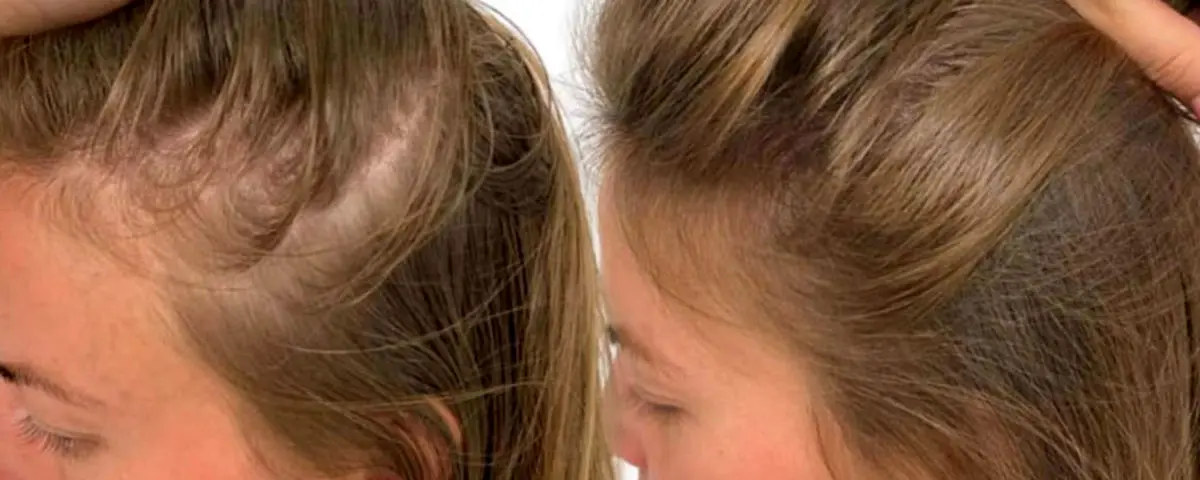 عوارض کاشت موی سر در زنان؛ 10 خطر مهم قبل از پیوند مو
