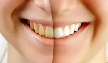 راه ارزان جرم گیری و سفید کردن دندان‌های زرد در خانه+ دستورالعمل