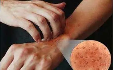 امید تازه برای درمان اگزما 