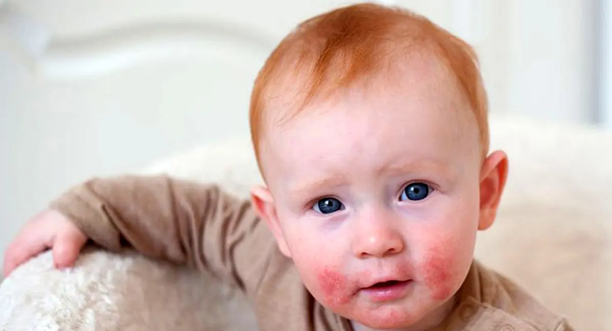 معمول‌ترین مشکلات پوستی در کودکان: علائم و درمان