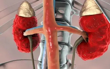 درمان عفونت کلیه