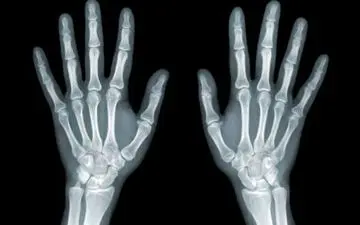 روشی جدید برای مقابله با متاستاز استخوانی