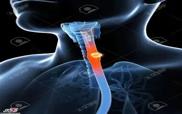 «سرطان مری» بر اثر افراط در مصرف پرطرفدارترین نوشیدنی ایرانی