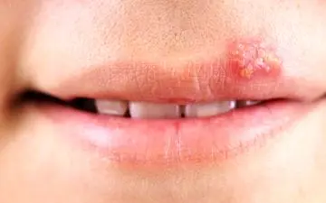 تبخال را سه دقیقه ای از بین ببرید