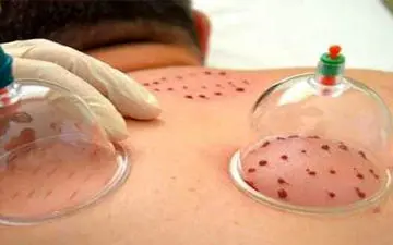 برای رفع کمردرد حجامت انجام ندهید