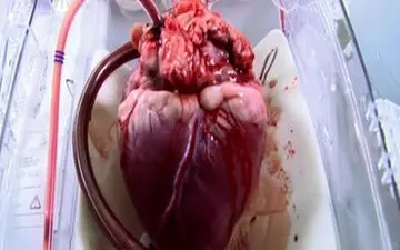 انجام دهمین بیمار پیوند قلب در تبریز