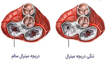 تنگی دریچه میترال