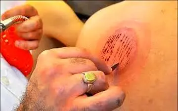 حجامت، درمان و پیشگیری نمی کند 