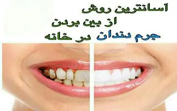  جرم گیری طبیعی دندان ها در منزل/ بیا تا 6 روش نشونت بدم!