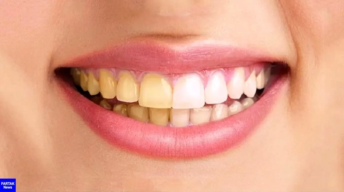  زردی دندان‌ها نشانه چیست؟