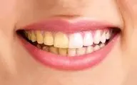  زردی دندان‌ها نشانه چیست؟
