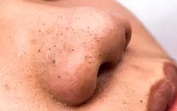 از شر  دانه‌های سرسیاه پوستی خلاص شوید!