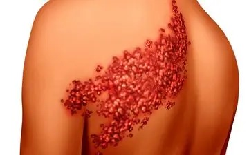 کسی که آبله‌مرغان نگرفته زونا می‌گیرد؟

