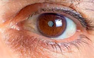 نگاهی به علایم ابتلا به آب مروارید

