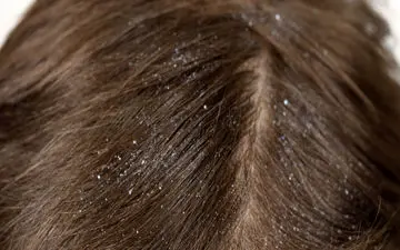 بهترین و سریع ترین روش درمان شپش موی سر