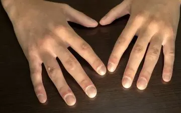 وقتی ناخن‌ها از سرطان ریه خبر می‌دهند؛ نشانه‌ای خطرناک که نباید نادیده بگیرید