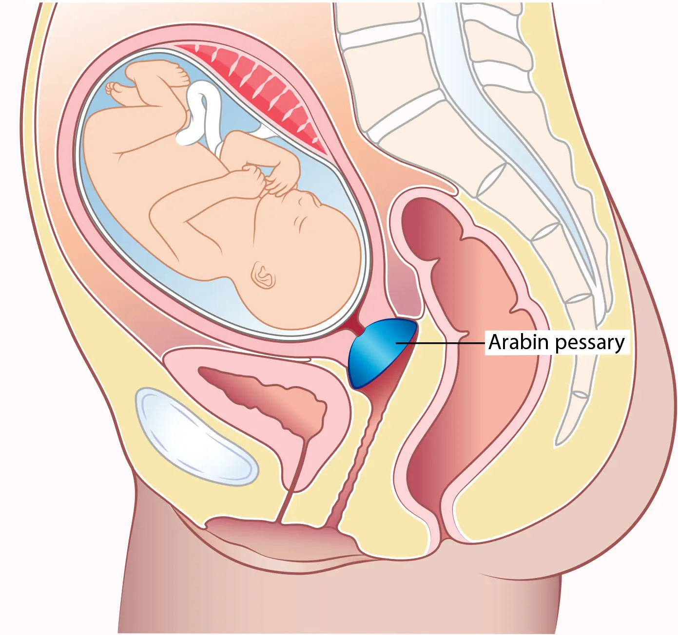 عمل سرکلاژ دهانه رحم چیست؟