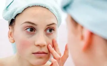 آیا بیماری لوپوس واگیر دارد؟