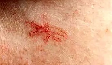 دلیل ظهور «رگ‌های عنکبوتی» (روزاسه) روی صورت چیست؟
