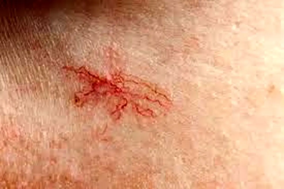 دلیل ظهور «رگ‌های عنکبوتی» (روزاسه) روی صورت چیست؟