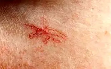 دلیل ظهور «رگ‌های عنکبوتی» (روزاسه) روی صورت چیست؟