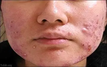 عواقب فشار دادن جوش های موجود در مثلث خطر