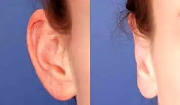 گوش بَلبَلی درمان دارد؟