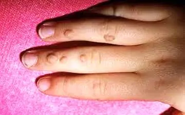 آیا زگیل‌های پوستی خطرناک هستند؟