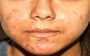 تاثیر نوردرمانی در بهبود آکنه 

