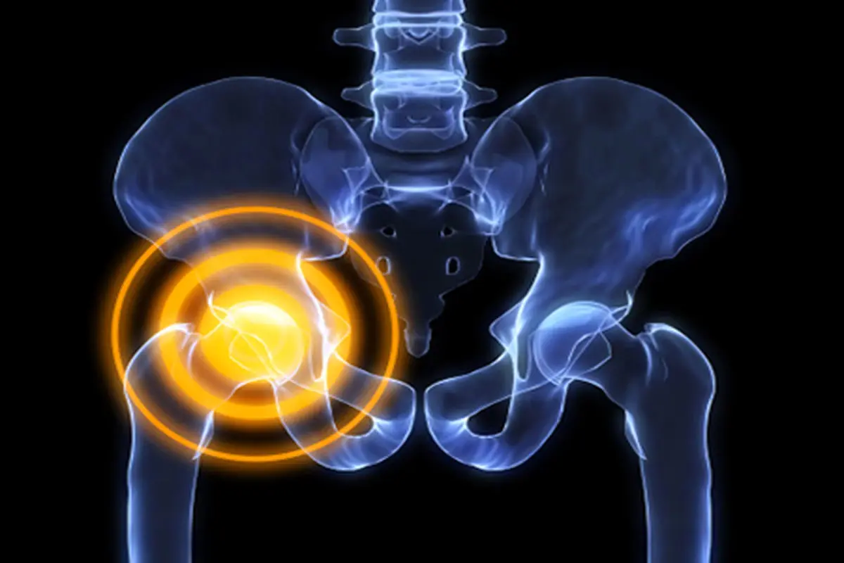 درد کشاله ران زنان| چرا کشاله ران زنان درد می‌گیرد؟ 10دلیل درد کشاله ران سمت راست زنان را بدانید