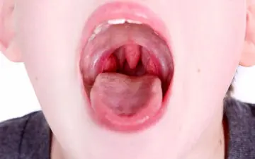 درمان خانگی برای از بین بردن سنگ لوزه