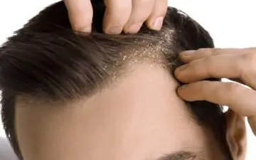 علت شوره سر چیست؟