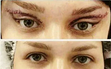 جراحی به اصطلاح زیبایی گوش الاغی و چشم گربه‌ای! +فیلم