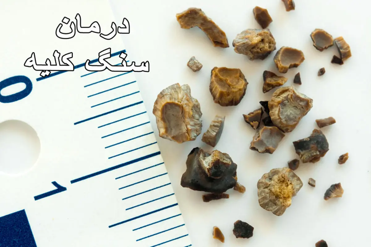 چطور از ایجاد سنگ کلیه پیشگیری کنیم؟