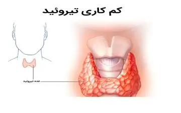 بی علامتی مشکل تیروئید در نوزادان؛غربالگری بهترین راهکار!