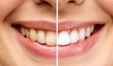 رنگ دندان چه چیزهایی درباره سلامت شما می‌گوید؟