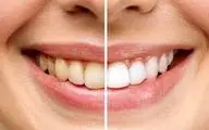 رنگ دندان چه چیزهایی درباره سلامت شما می‌گوید؟