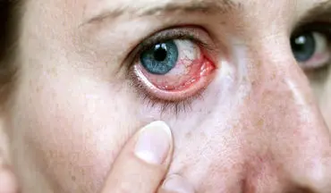 حساسیت چشم (آلرژی چشم) چیست و چگونه بروز می کند؟