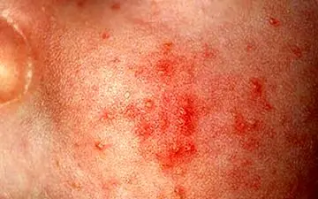 آکنه نوزادی چگونه درمان می شود؟