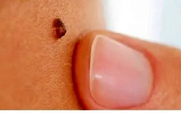 عواملی که باعث خارش یک خال می شود