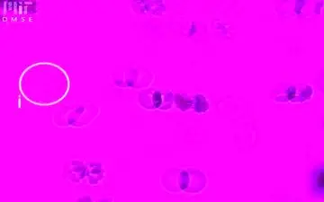 حقایقی درباره کم‌خونی