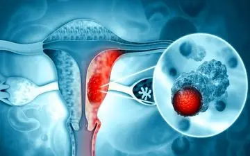 علایم شایع سومین سرطان شایع زنان چیست؟ | بهترین سن برای تزریق واکسن HPV برای زنان |آیا مردان هم می‌توانند واکسن HPV بزنند؟
