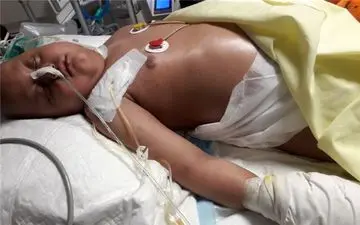 قطع دست اتفاقی علیرضای ۶ ساله + تصاویر( ۱‌۸‌ +)