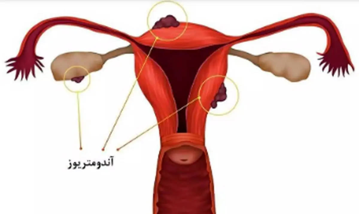 آیا فیبروئیدها و اندومتریوز می‌توانند طول عمر را کوتاه کنند؟