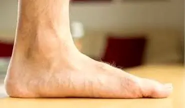 میخوای بدونی کف پاهات صاف است یا نه؟ روش صحیح تشخیص+پیشگیری و درمان!