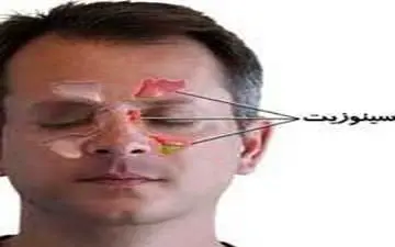 چگونه عفونت سینوس را درمان کنیم؟