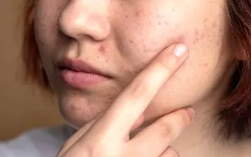 غذاهای جوش آور؛ چه غذاهایی باعث جوش زدن صورت می شود