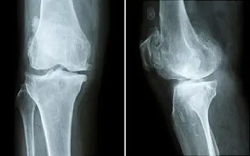 تست تراکم استخوان برای چه افرادی ضروری است