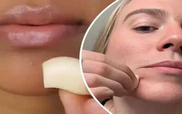 سیر خام آکنه را درمان می‌کند؟
