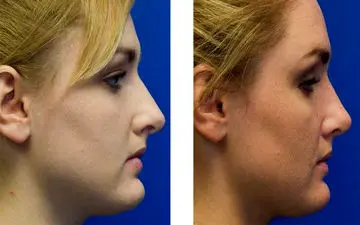 ترمیم افتادگی نوک بینی